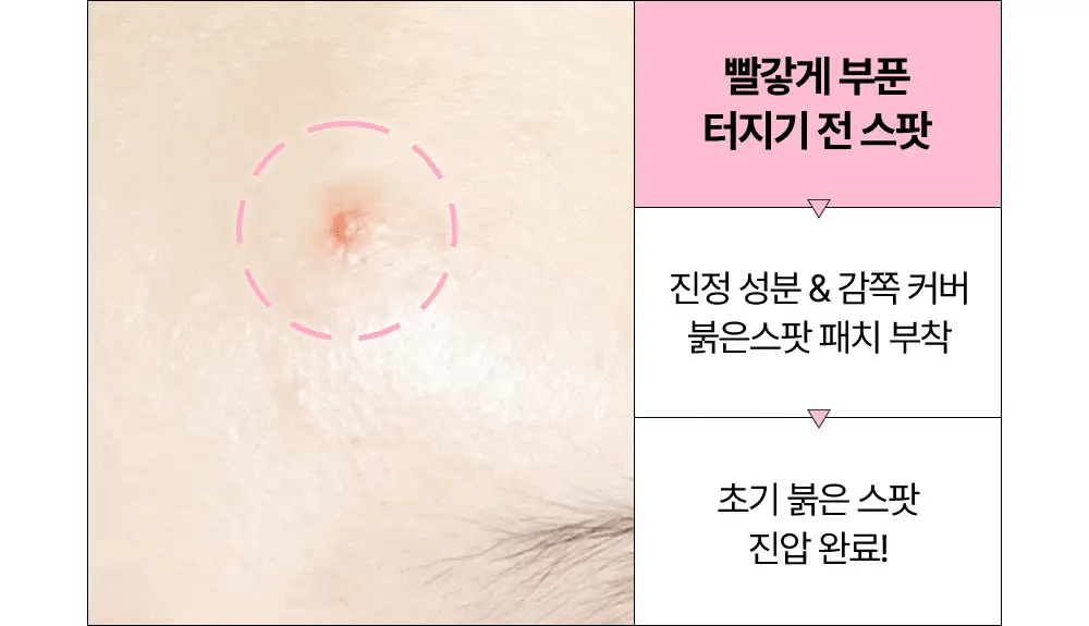 [올영단독기획 / 짜기 전/후 구성] 해서린 스팟케어 패치 키트 대용량 기획 140매 상세페이지 21